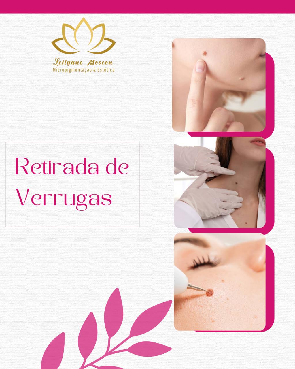RETIRADA DE VERRUGA