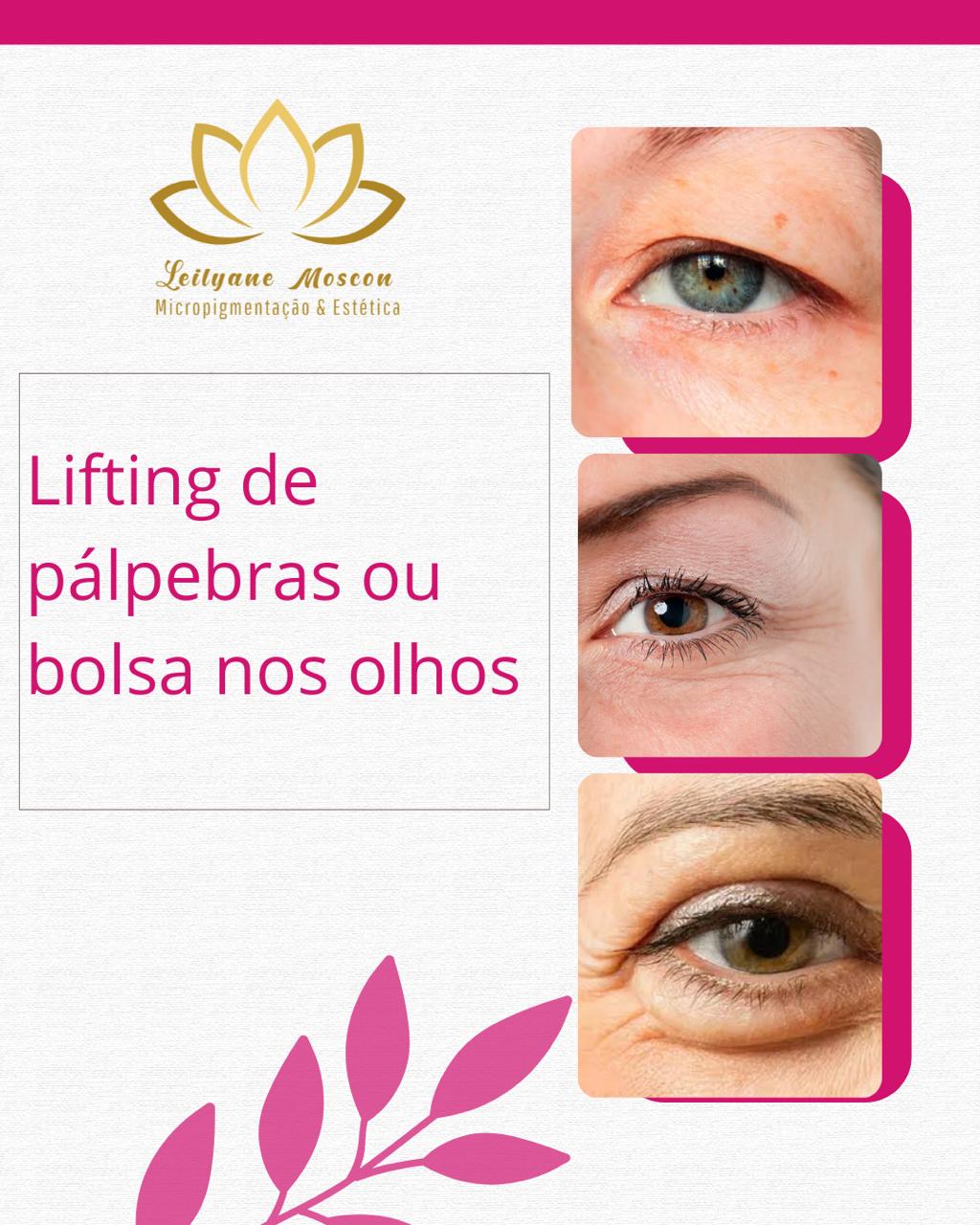 LIFTING DE PÁLPEBRAS OU BOLSAS