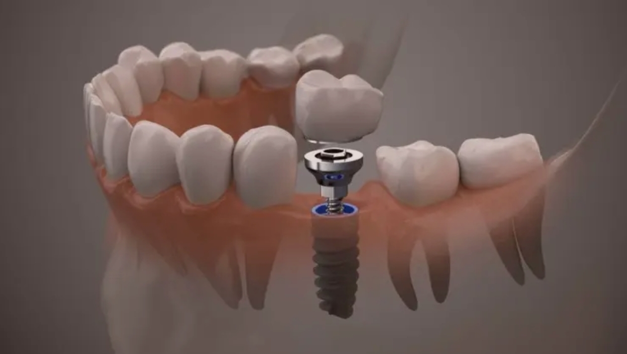 IMPLANTE DENTÁRIO